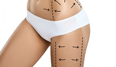 Buttock Augmentation