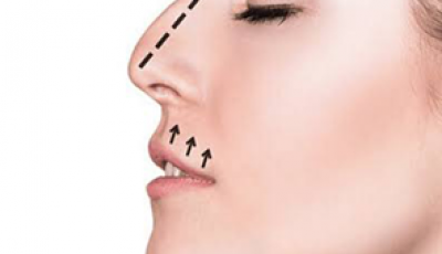 Rhinoplastie