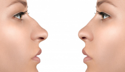 What Are The Methods Of Rhinoplasty?