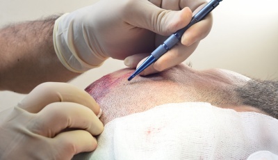 Trasplante de cabello con FUE Zafiro