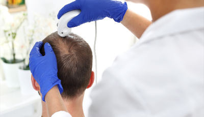 Come calcoliamo il prezzo del trapianto di capelli?