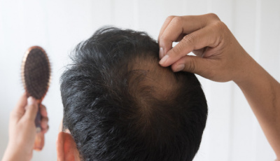 Well-Known Mistakes (DHI Hair Transplantation Techniques)