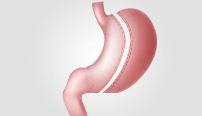 Sleeve Gastrectomy