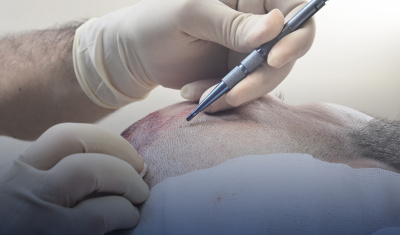 FUE-Haartransplantation zur Fixierung der Transplantate