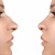 What Are The Methods Of Rhinoplasty?