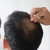 Well-Known Mistakes (DHI Hair Transplantation Techniques)